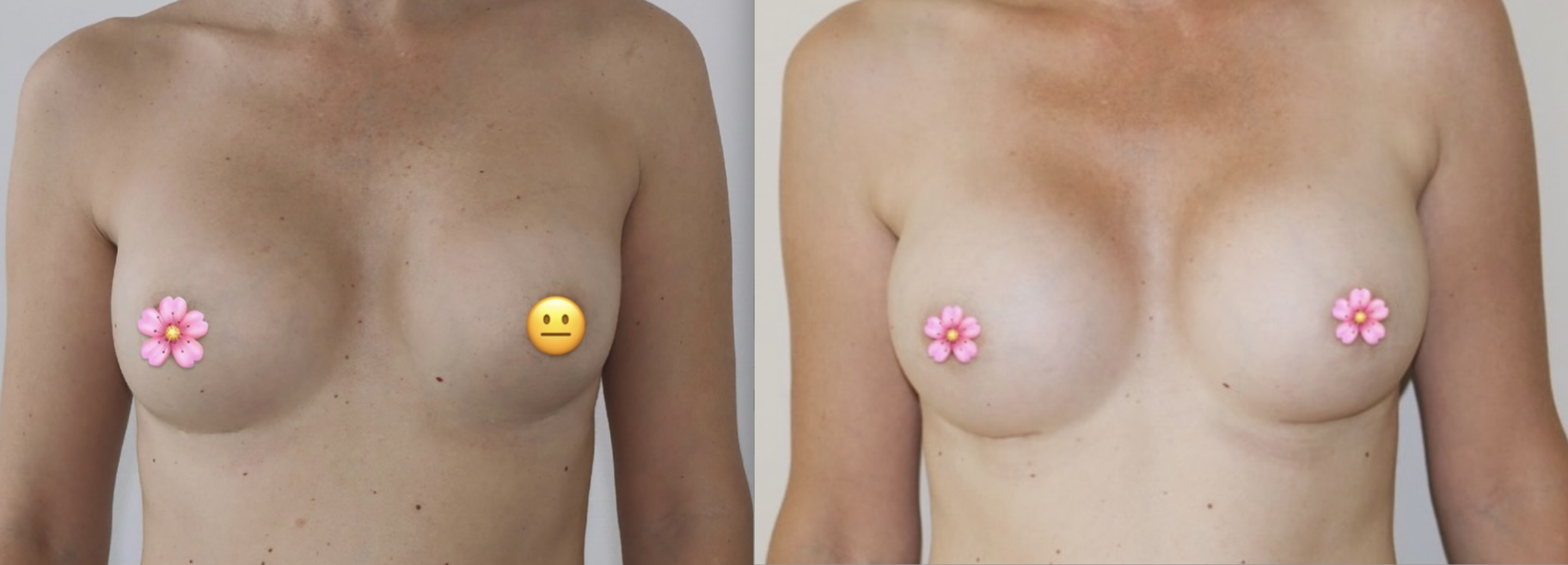 Avant/Après prothèses mammaires